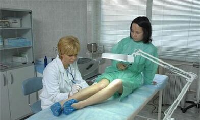 kako zdraviti krčne žile na nogah