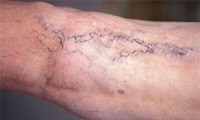 metode zdravljenja krčnih žil na nogah