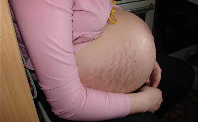 vzroki krčnih žil med nosečnostjo