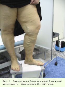 Krčne žile je treba zdraviti, da se proces ustavi