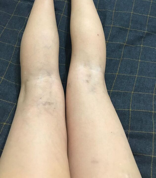 manifestacije krčnih žil na nogah