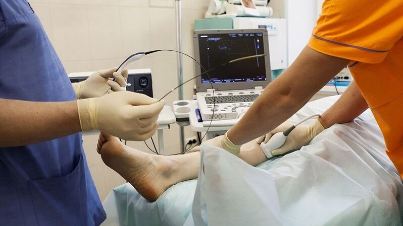 operacijo za odstranitev krčnih žil